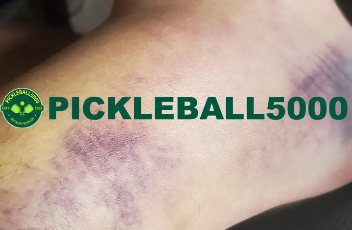 Inversion Ankle Sprain After Pickleball